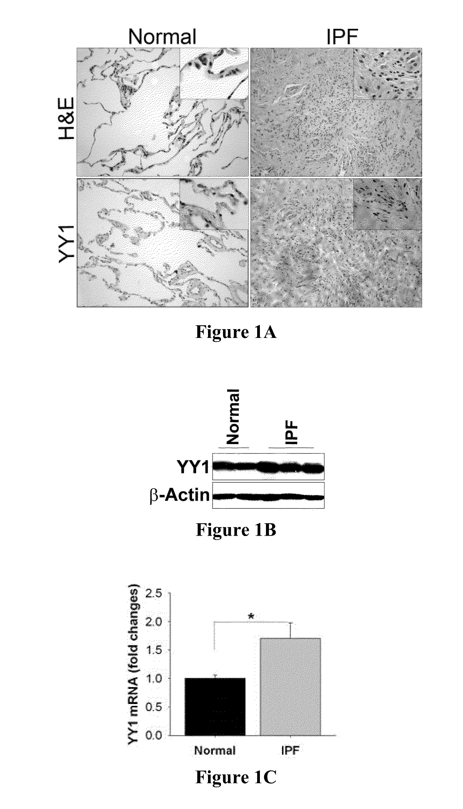 Methods of diagnosing and treating fibrosis