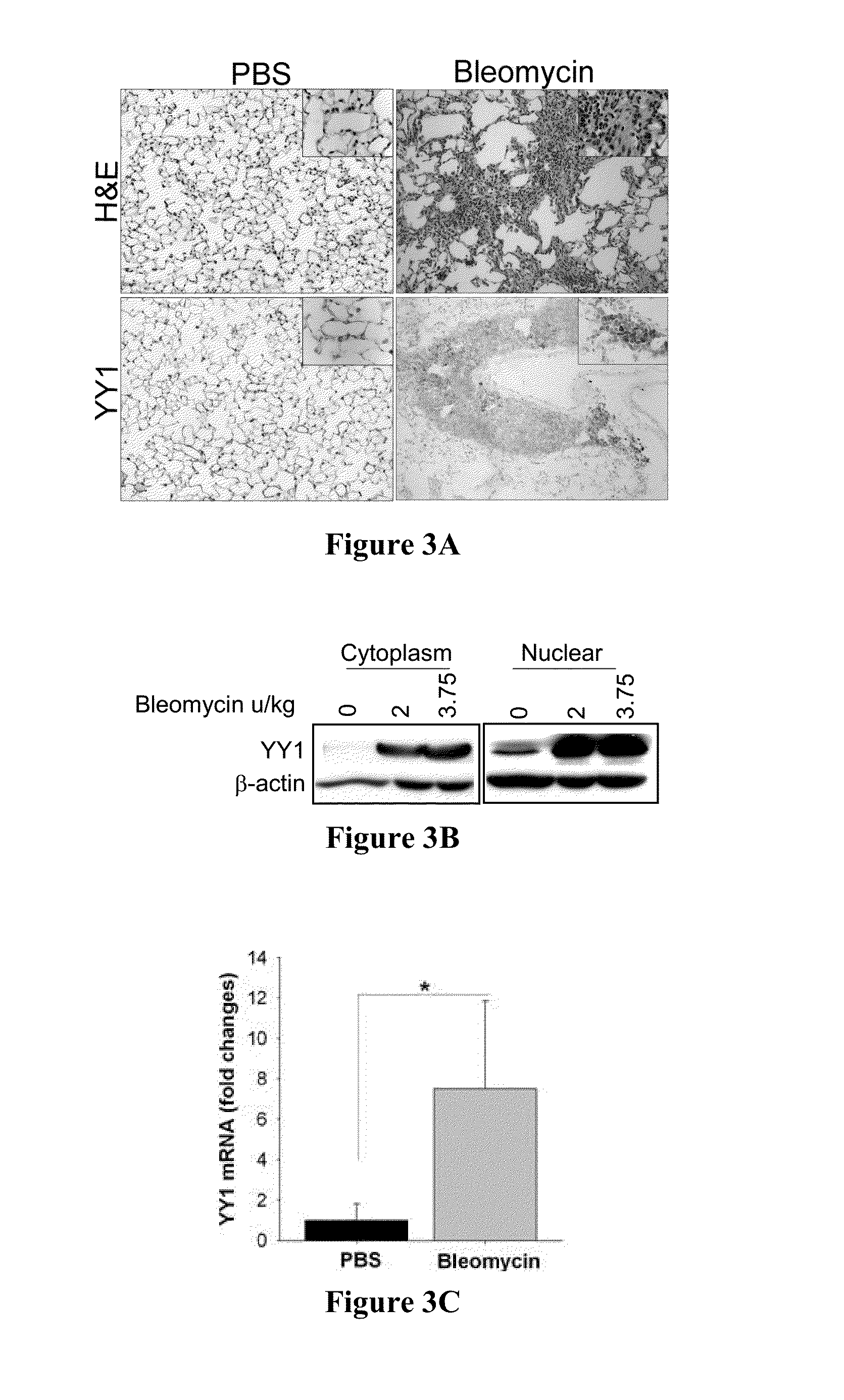 Methods of diagnosing and treating fibrosis