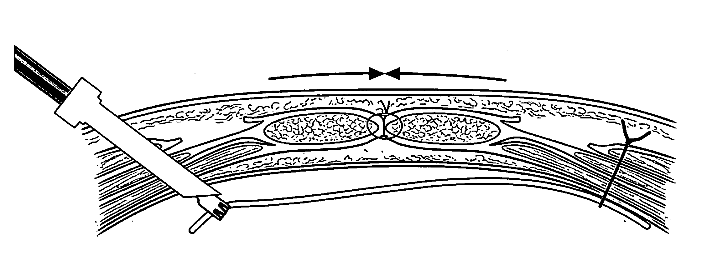 Apparatus and method for use of a biosurgical prosthetic rectus sheath