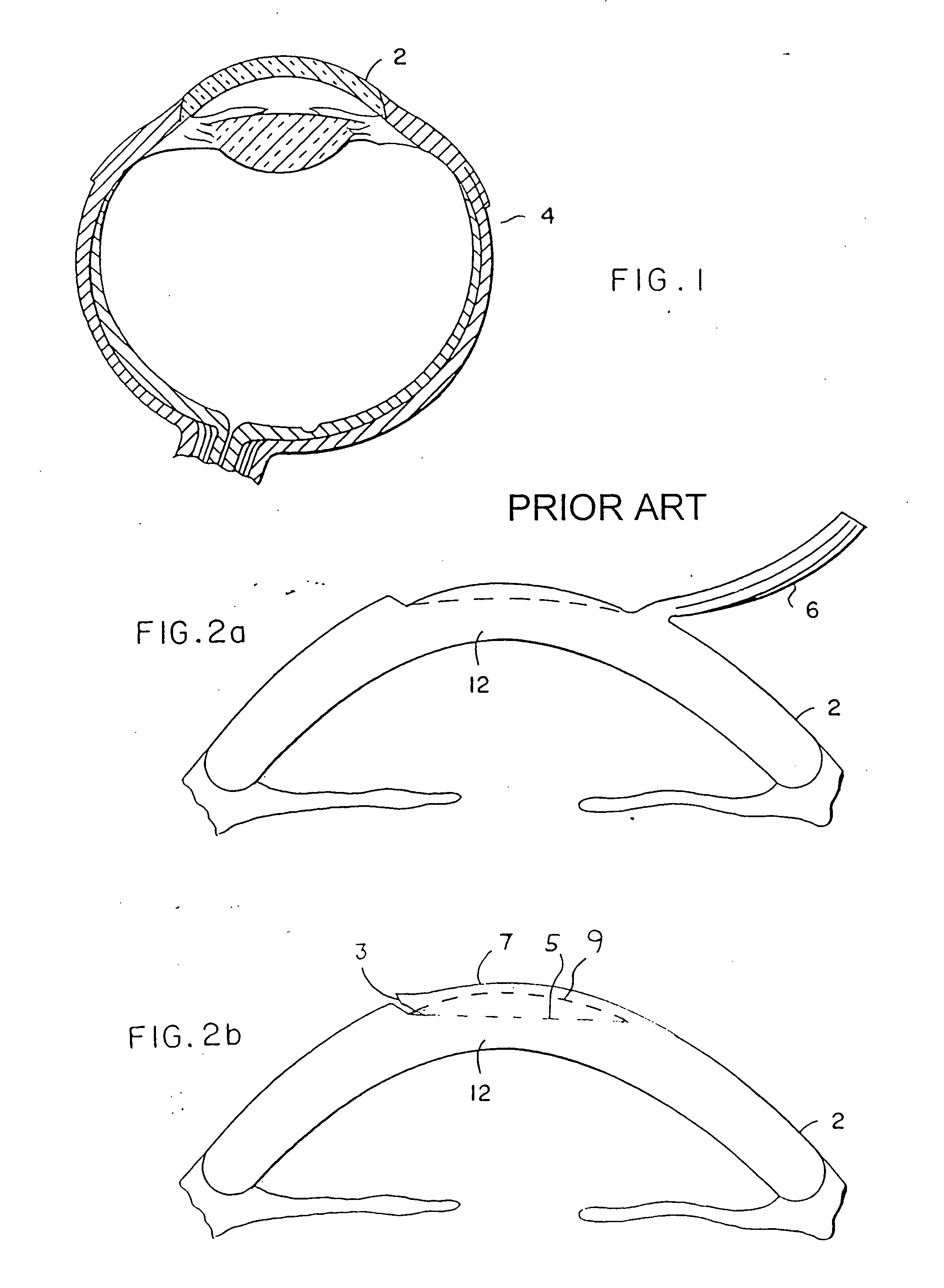 Intracorneal lens placement method and apparatus