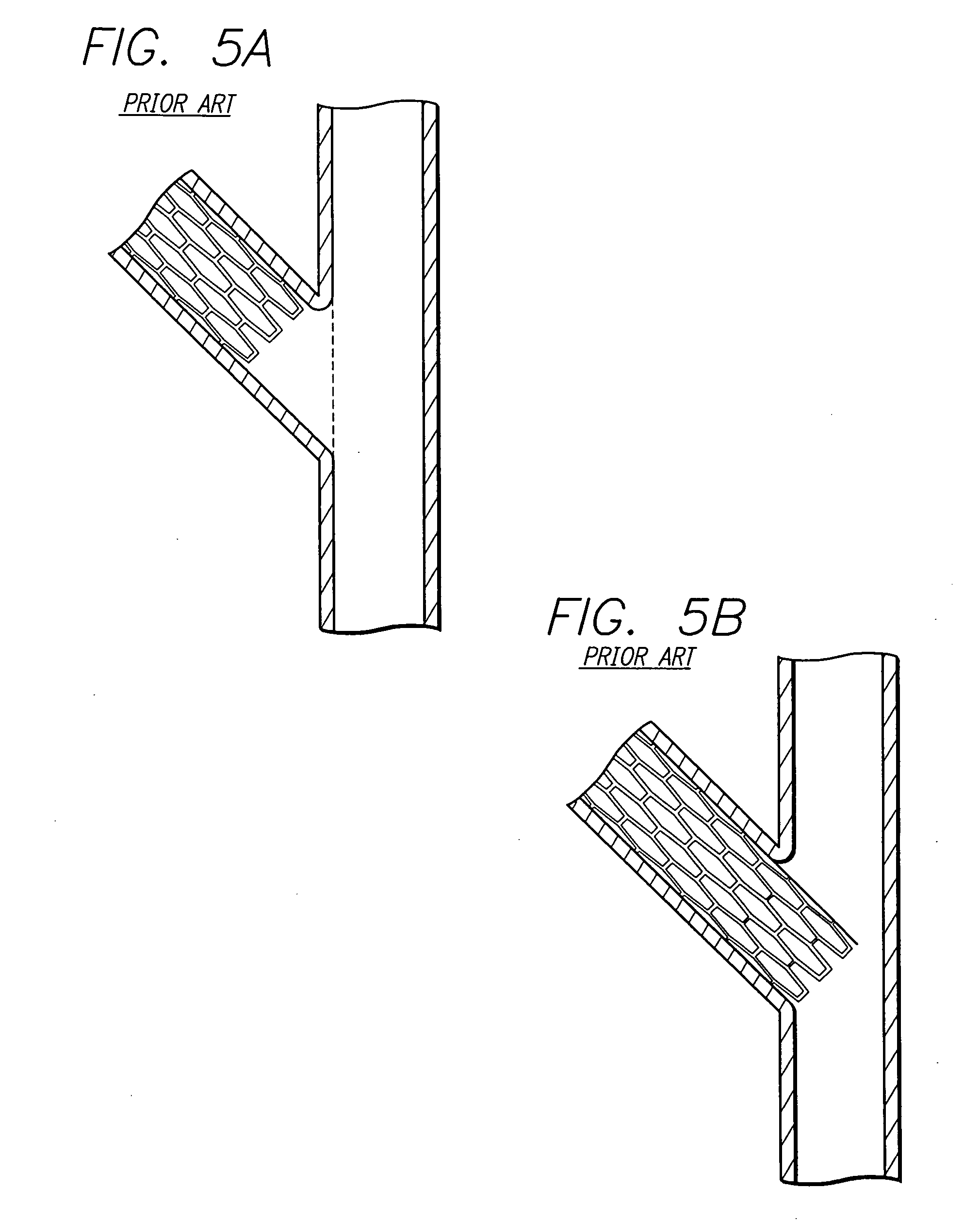 Stent and catheter assembly and method for treating bifurcations