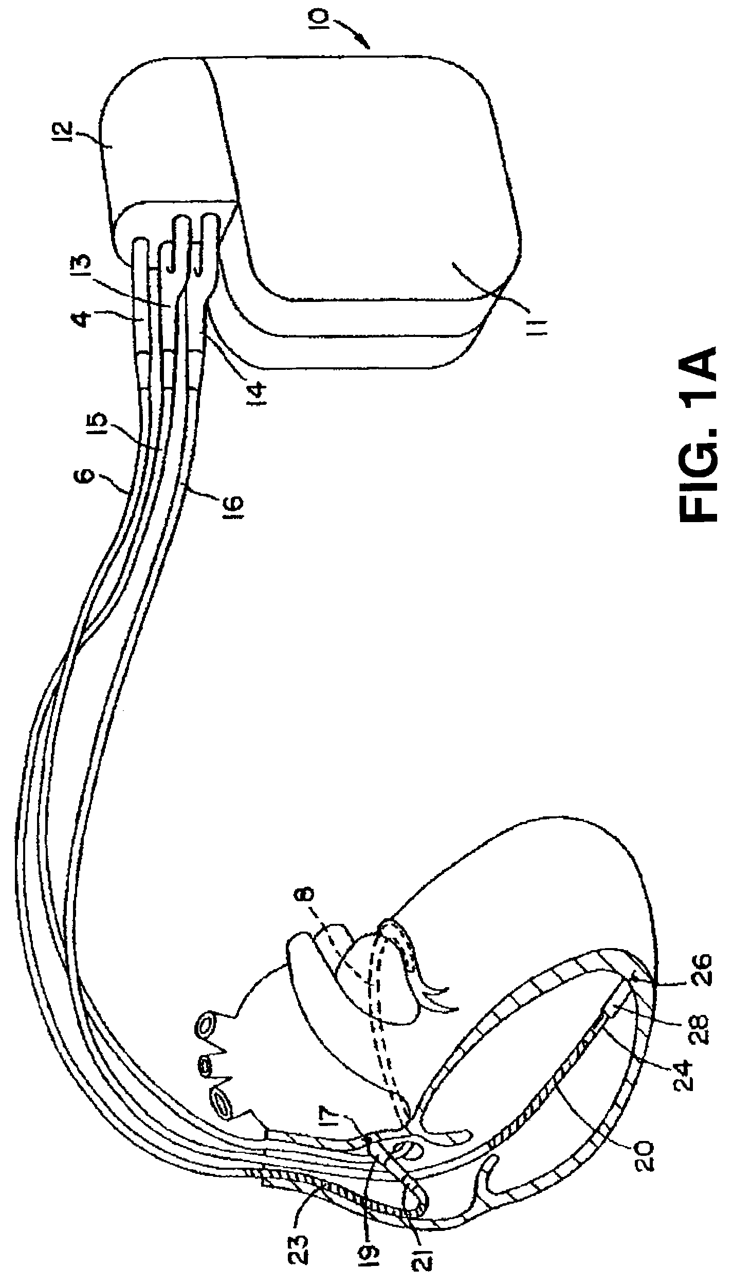Method for elimination of ventricular pro-arrhythmic effect caused by atrial therapy