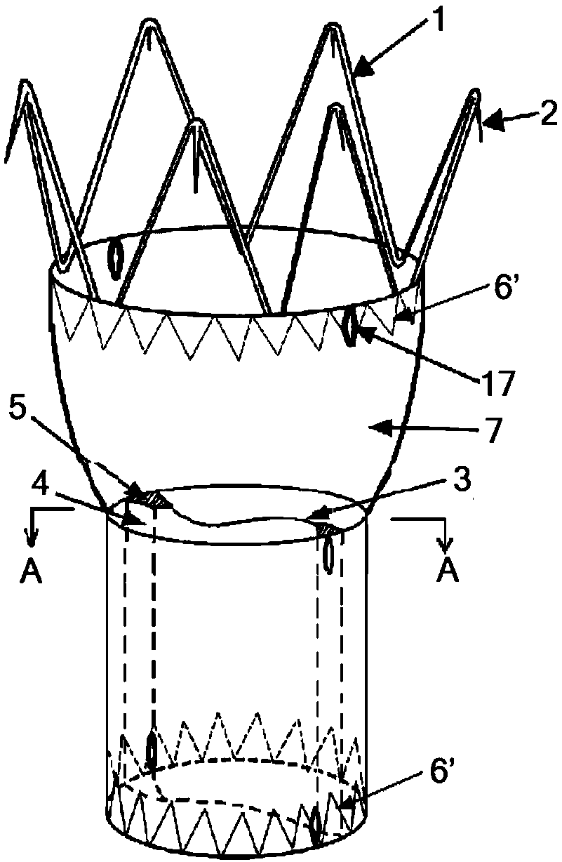 A combined abdominal aortic stent graft system and its application method