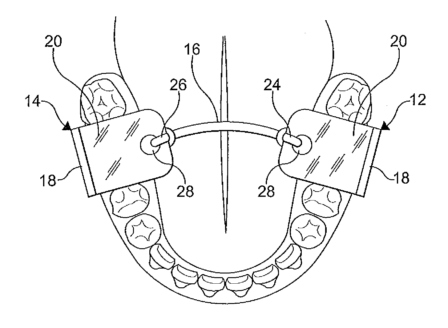 Speech therapy device