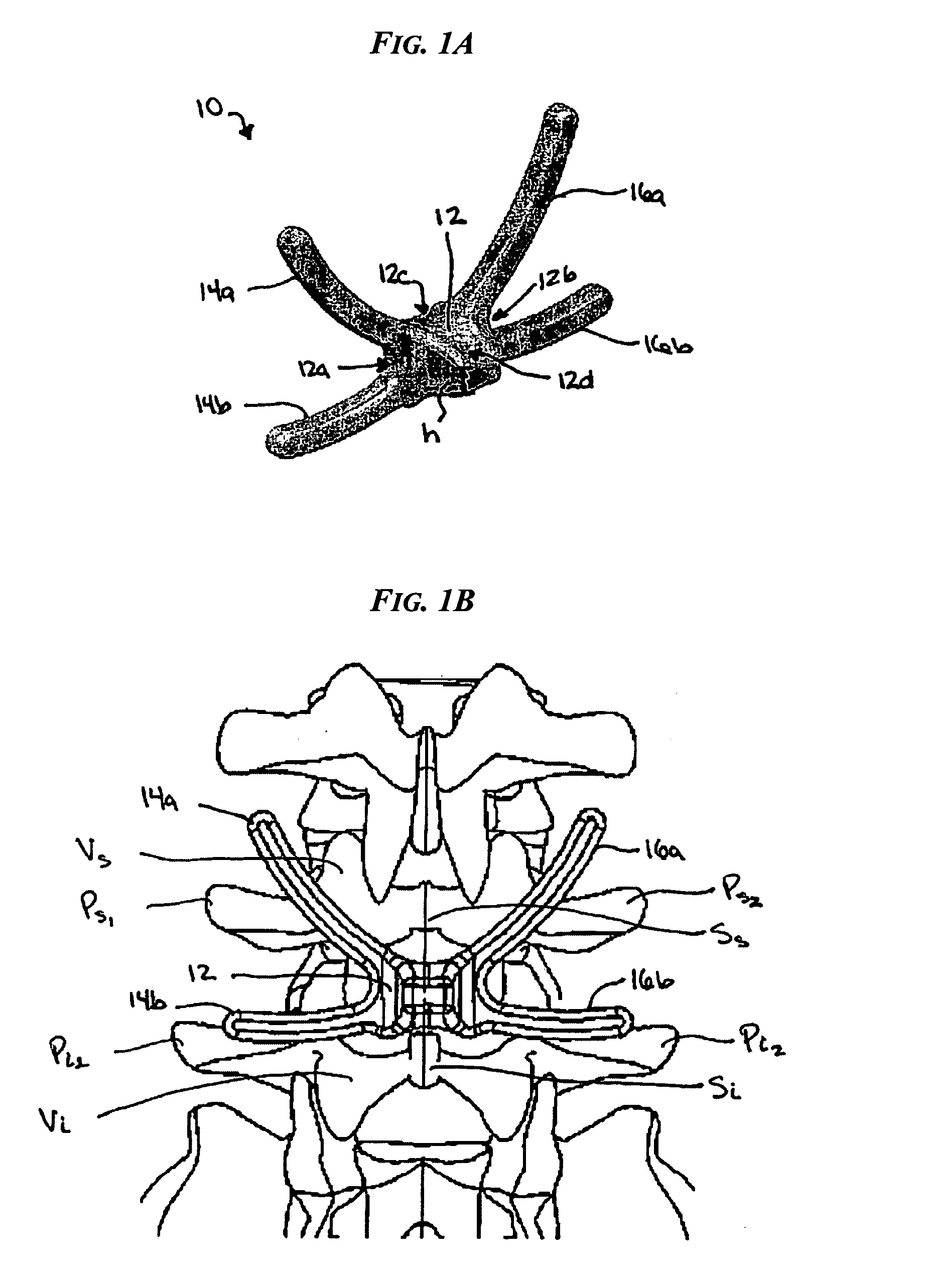 Posterior dynamic stabilization x-device