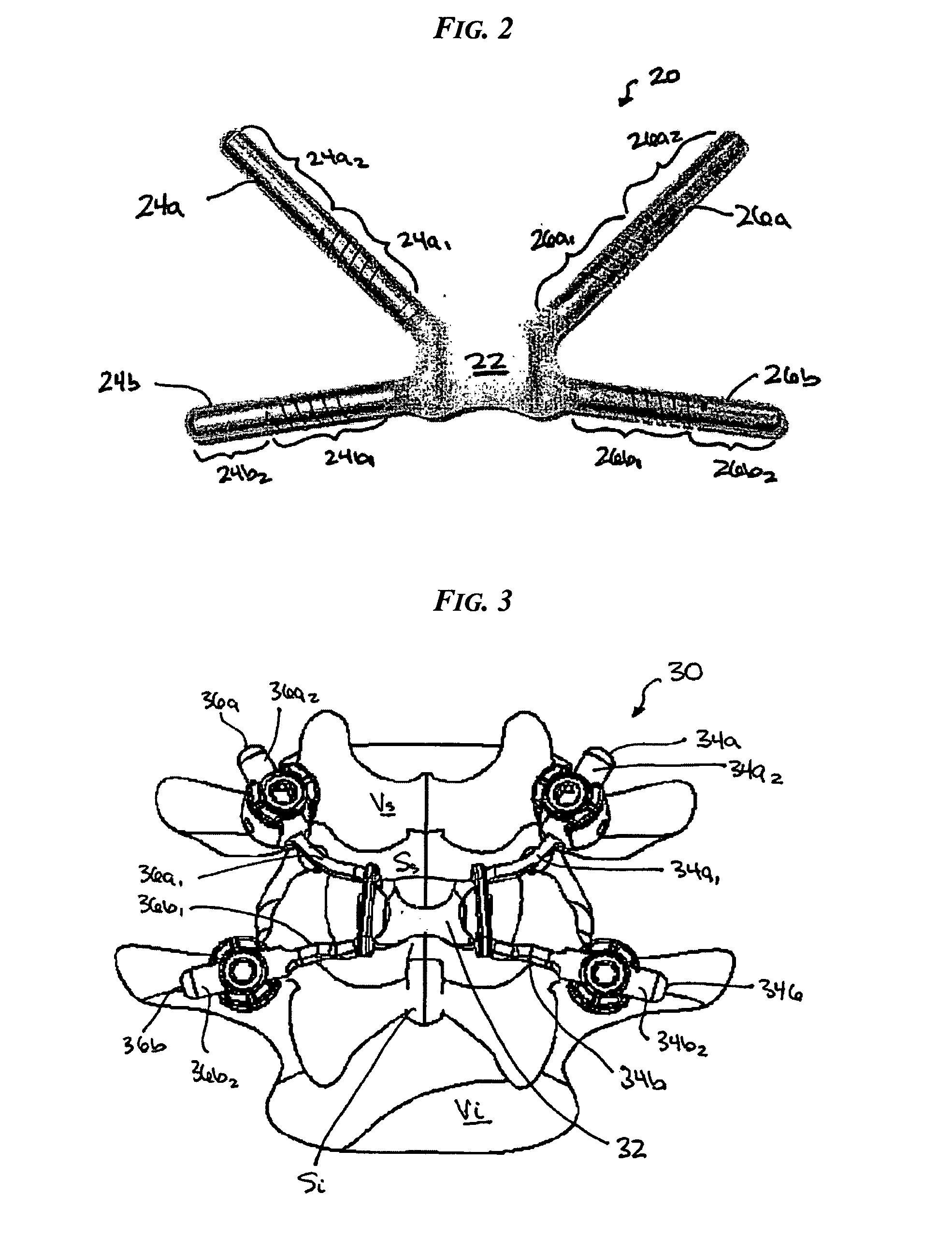 Posterior dynamic stabilization x-device