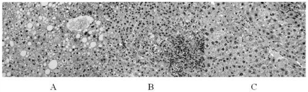 Application of lactobacillus plantarum L168 in assisting sorafenib in treating liver cancer