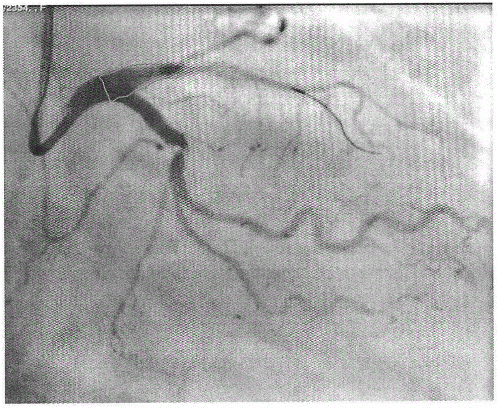 Method for preparing personalized bionic drug eluting coronary stent by using 3D printing technology