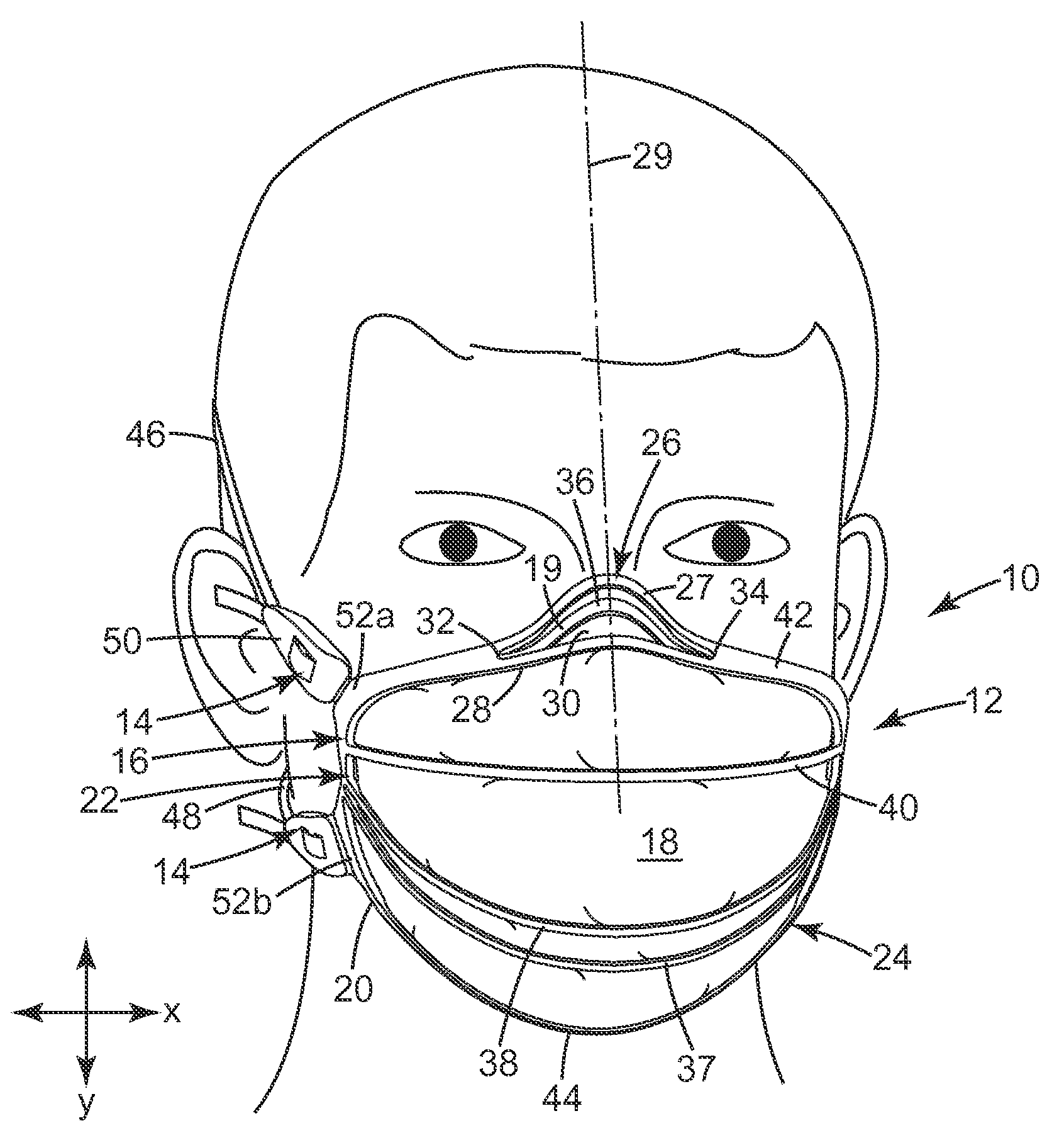 Filtering face-piece respirator having nose clip molded into the mask body