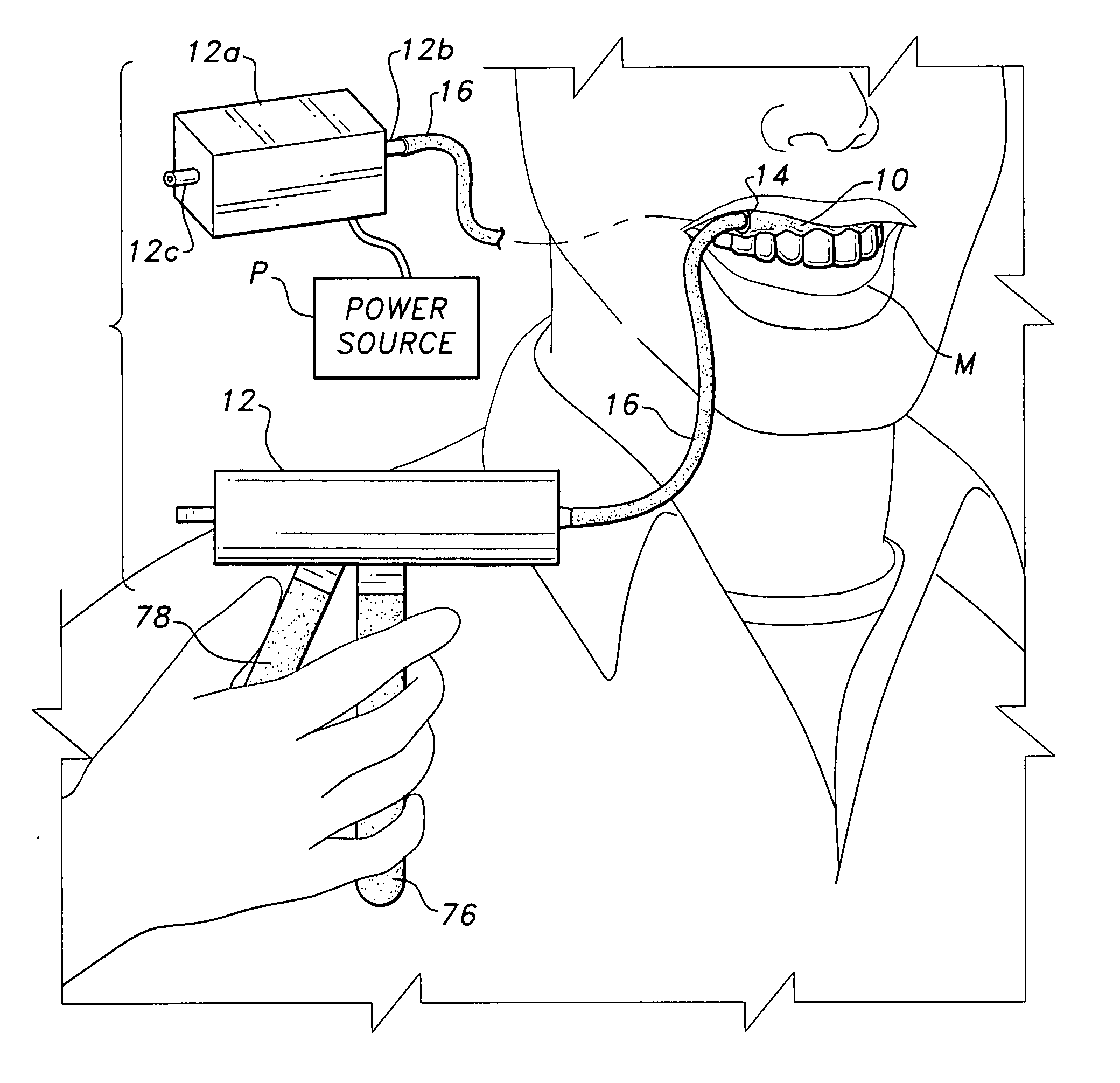 Denture with suction attachment