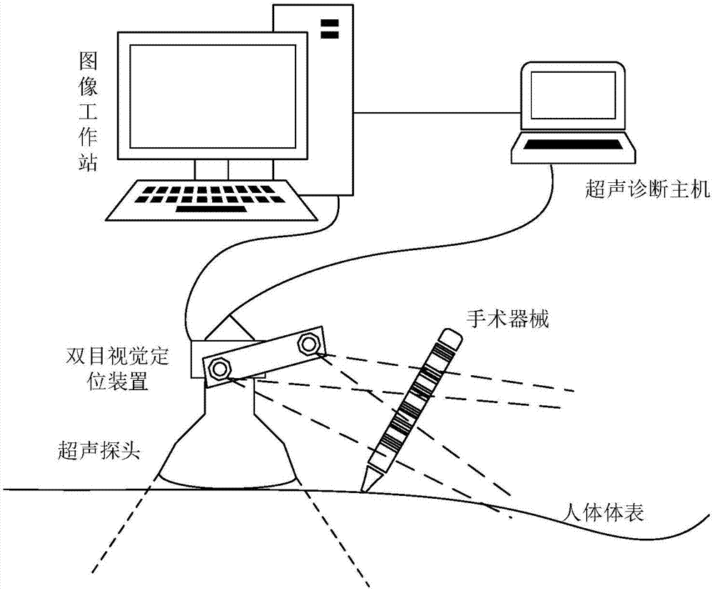 Ultrasound surgery assisted navigation system based on binocular vision