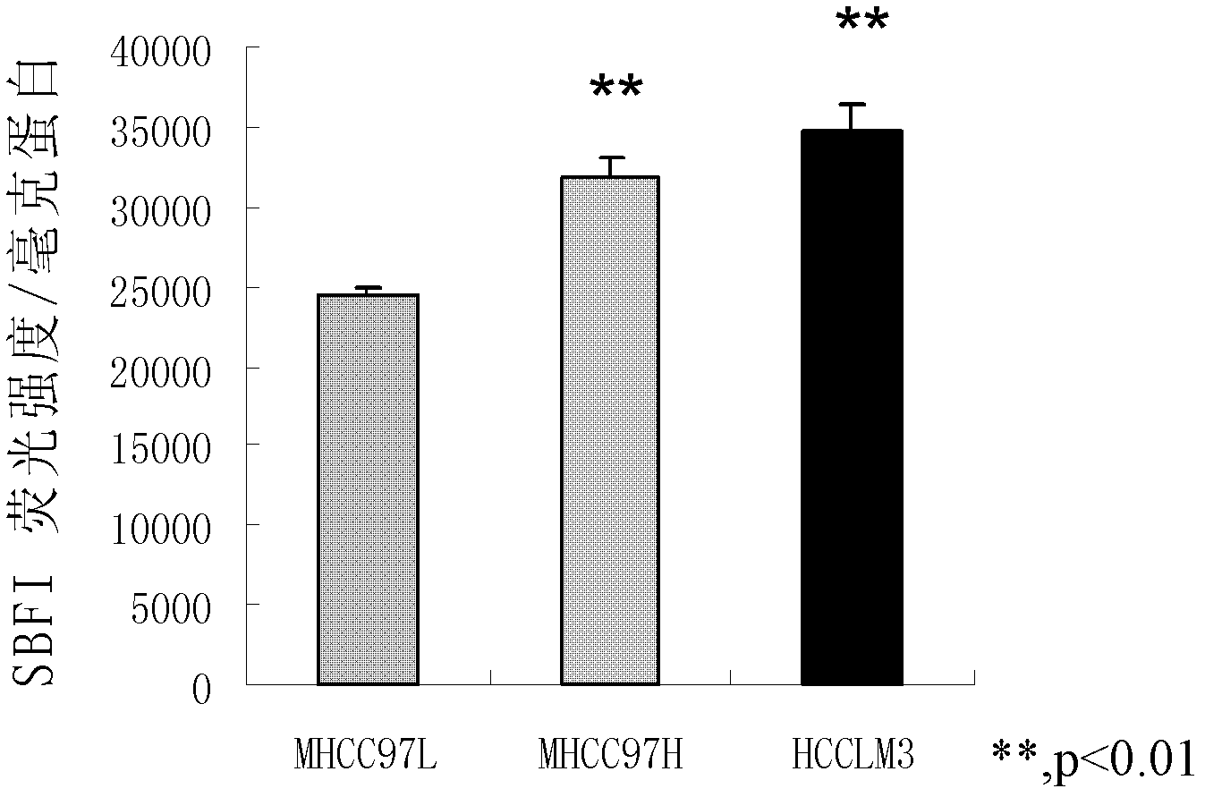 Application of bumetanide in inhibition of hepatoma cell transfer