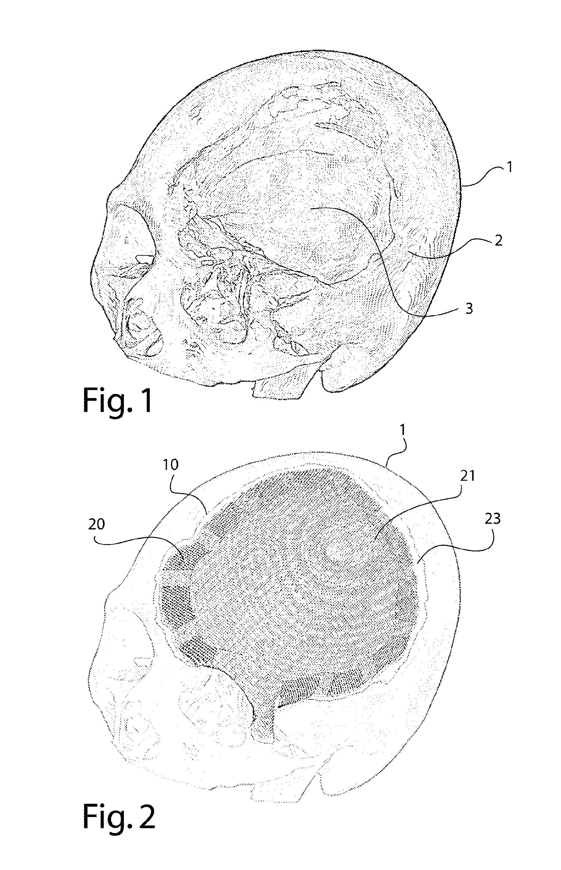 Reinforced biocompatible ceramic implant and manufacturing method thereof