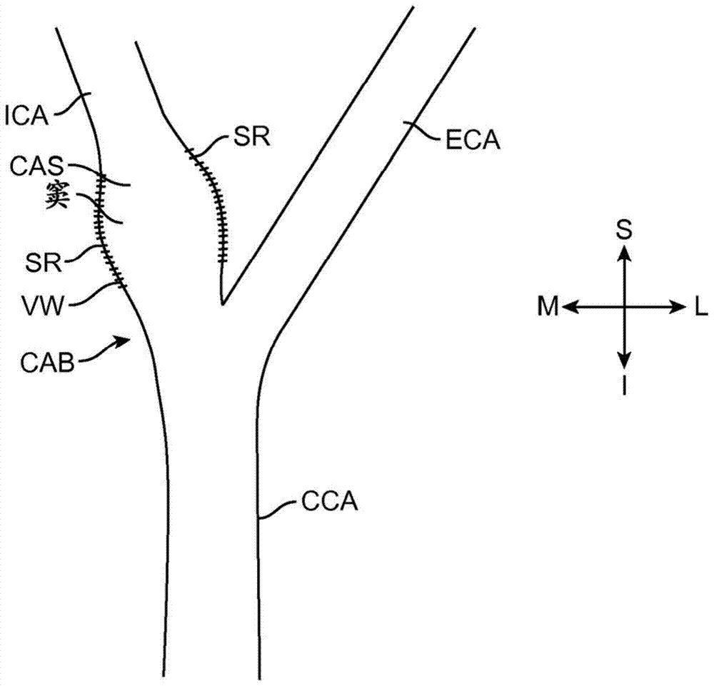 Implantable Vascular Devices with Longitudinal Struts