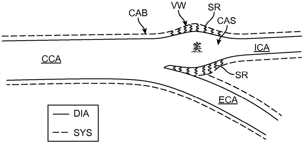 Implantable Vascular Devices with Longitudinal Struts