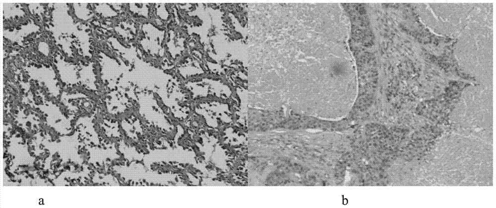 Plasma metabolic small molecule markers related to human non-small cell lung cancer and their application