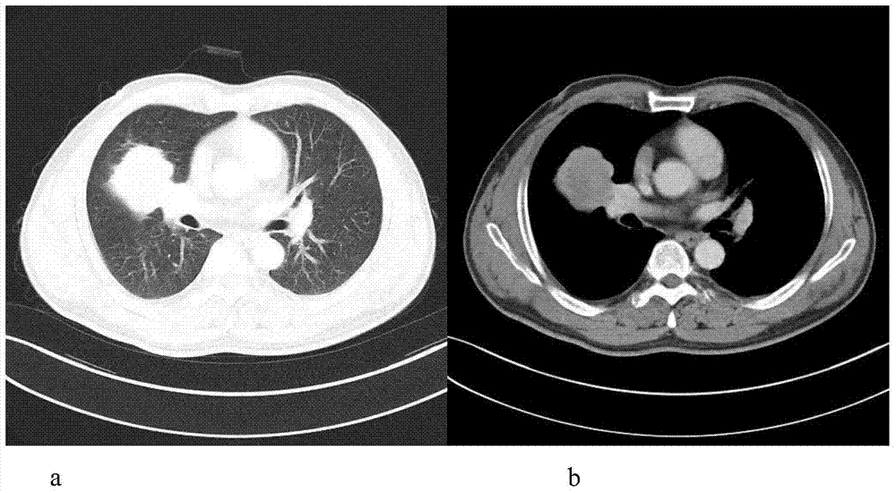 Plasma metabolic small molecule markers related to human non-small cell lung cancer and their application