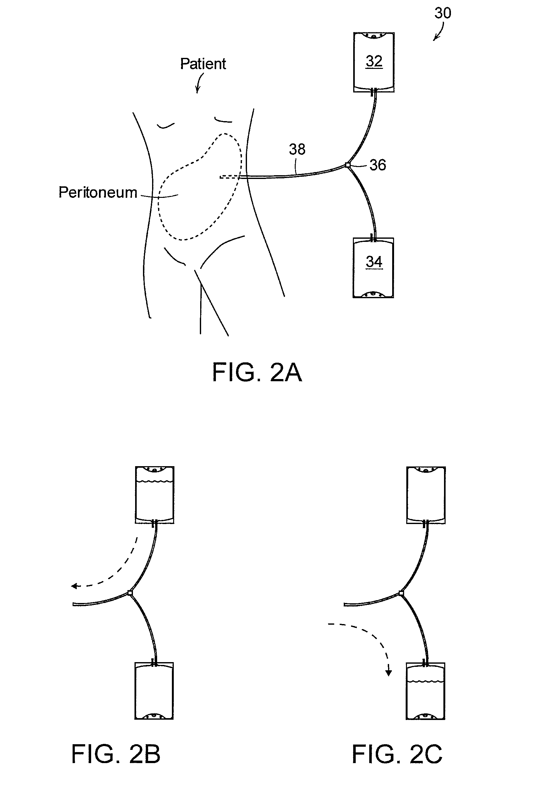 Apparatus and methods for early stage peritonitis detection and for in vivo testing of bodily fluid