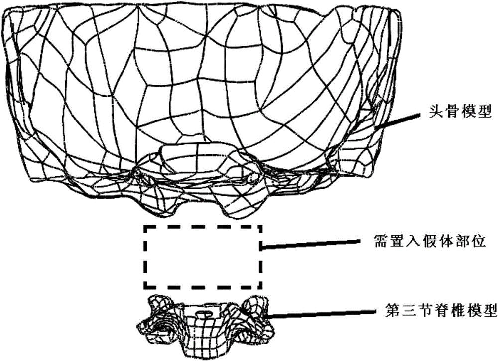 Manufacturing method of atlas and axis titanium alloy prosthesis