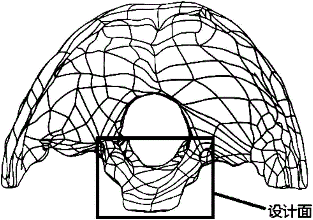 Manufacturing method of atlas and axis titanium alloy prosthesis