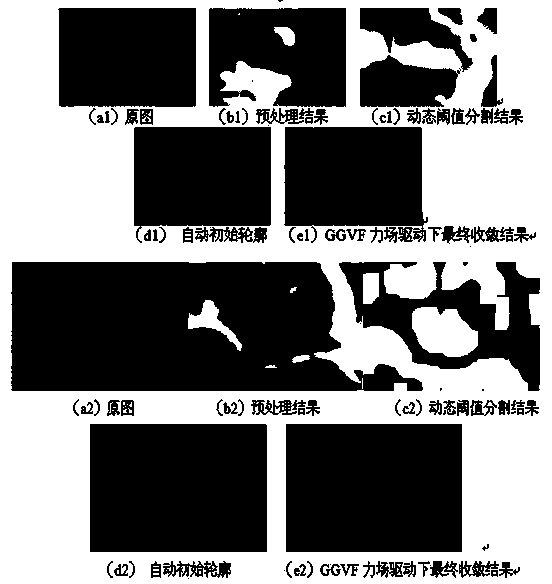 Method for acquiring initial contour in ultrasonic image segmentation based on active contour model