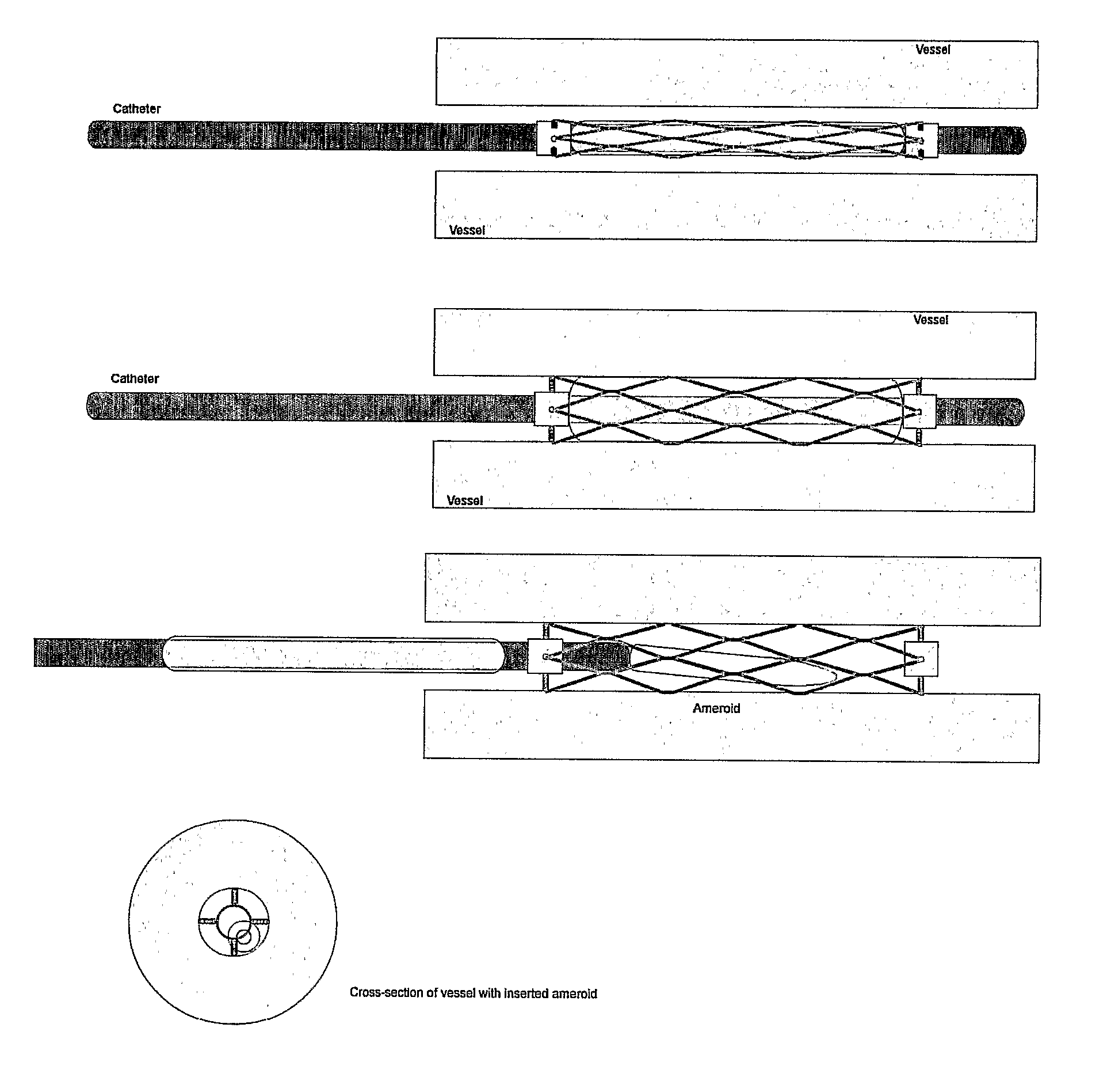 Devices, Systems and Methods for Controlling Local Blood Pressure