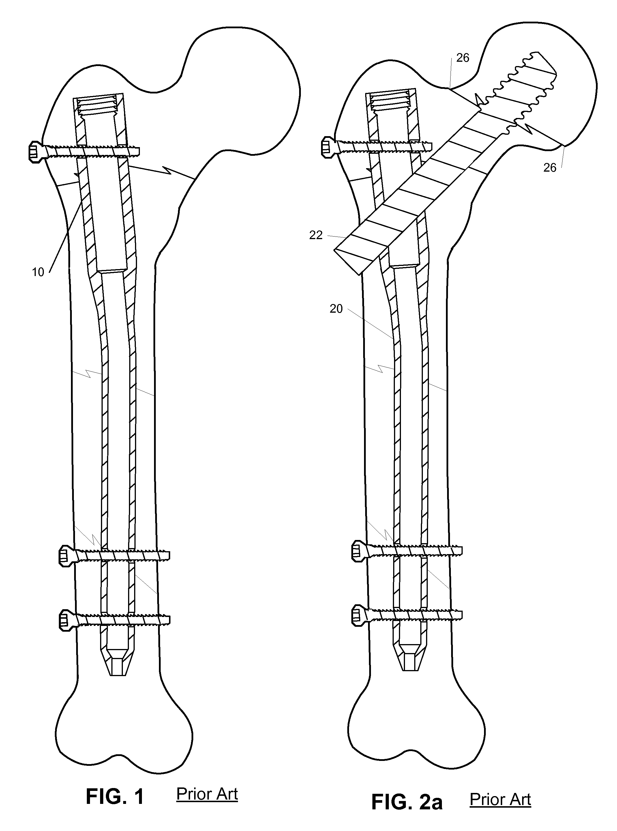 Femoral Universal Nail