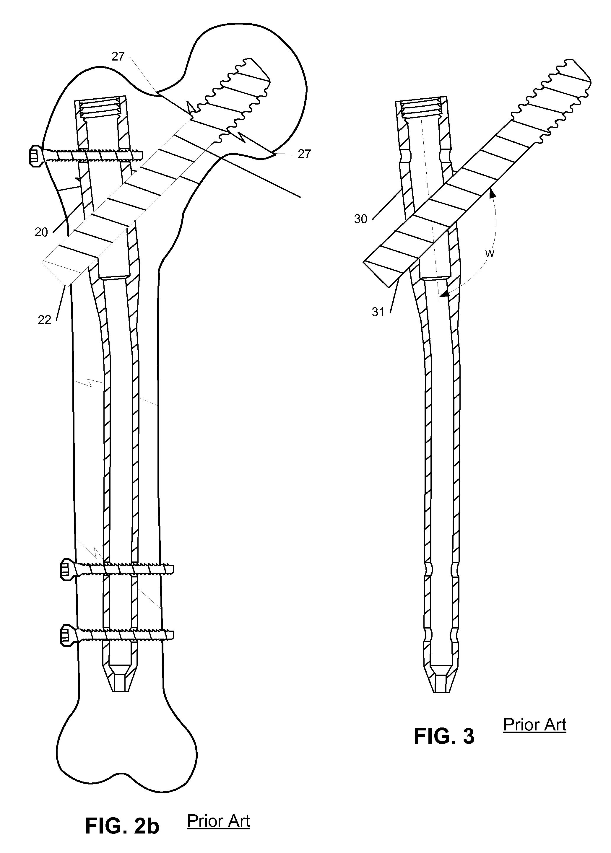 Femoral Universal Nail