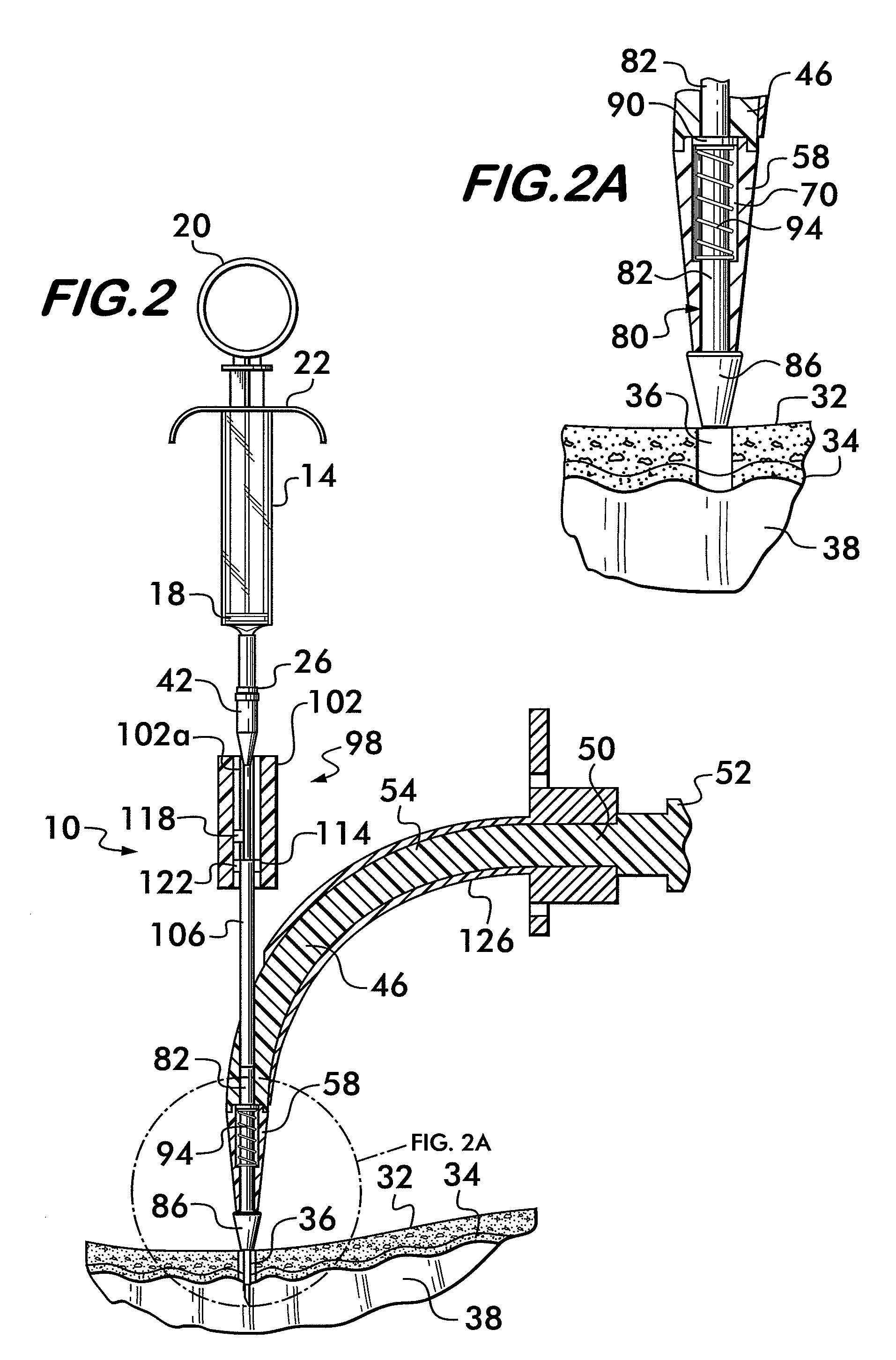 Methods and devices for performing an emergency or non-emergency tracheotomy