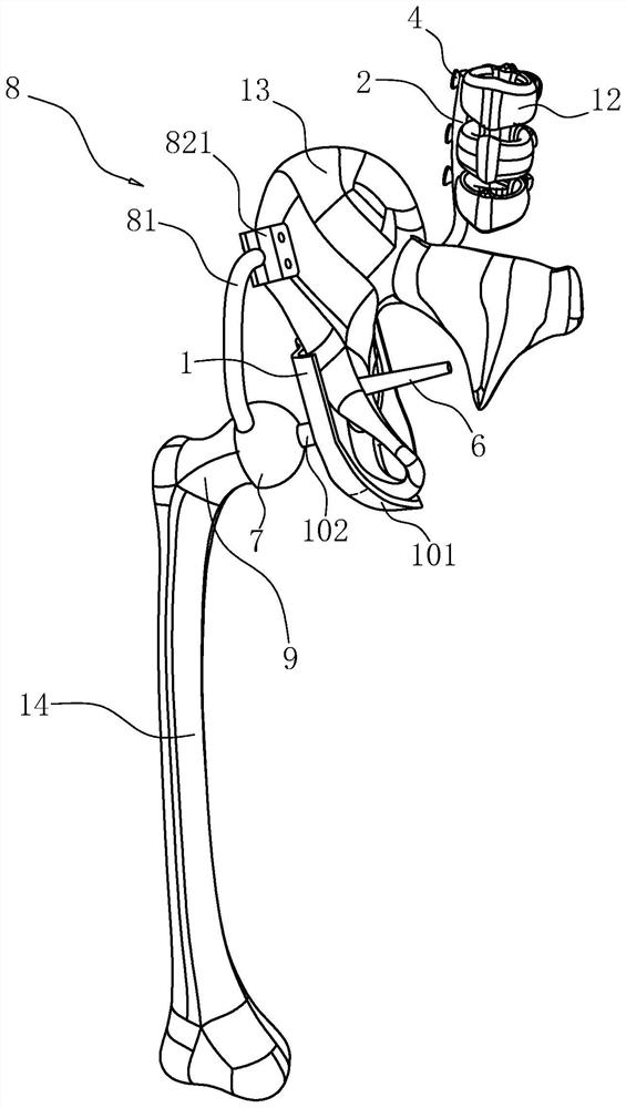 Fixing prosthesis for osteolysis therapy