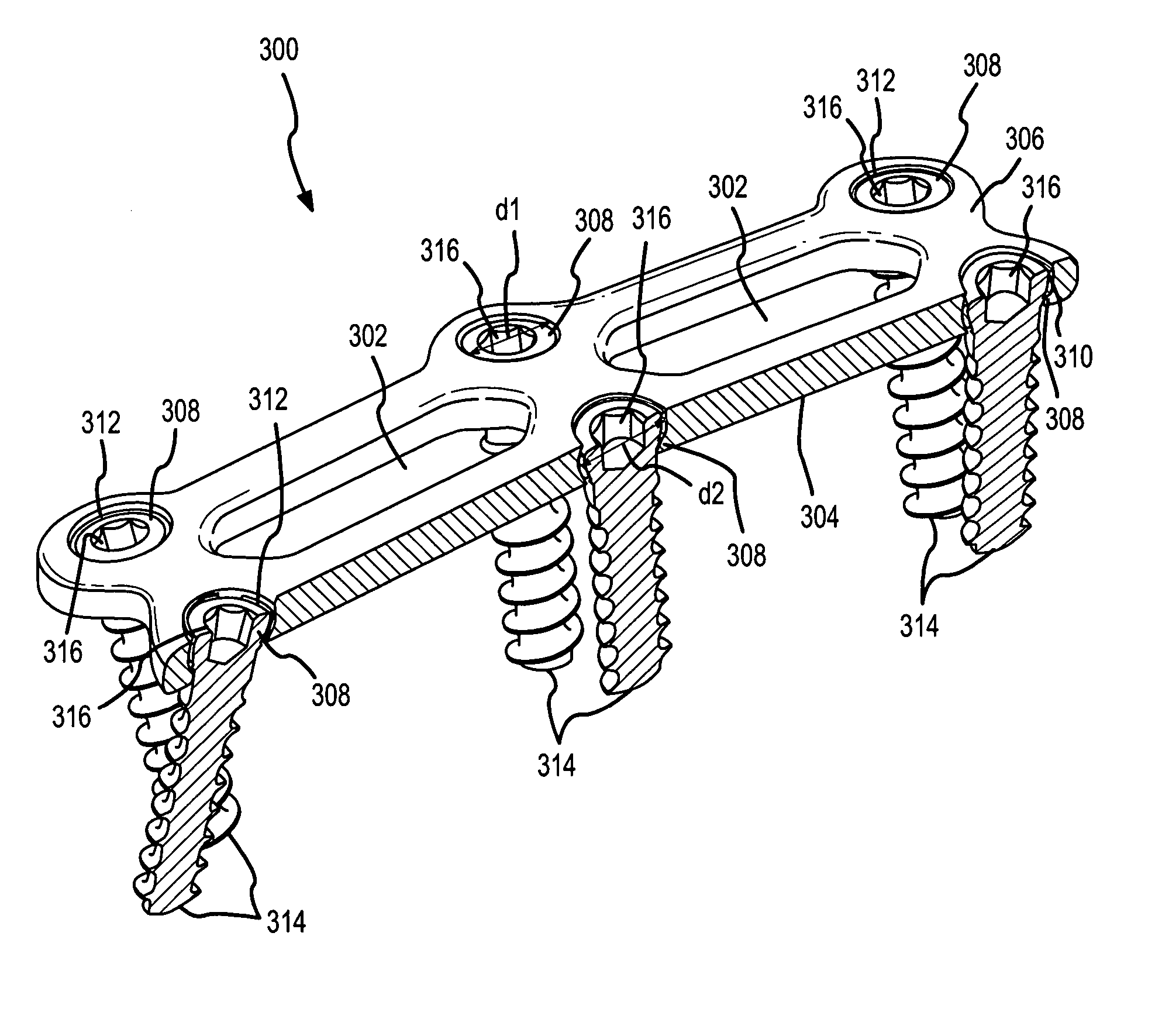 Cervical plate with backout protection