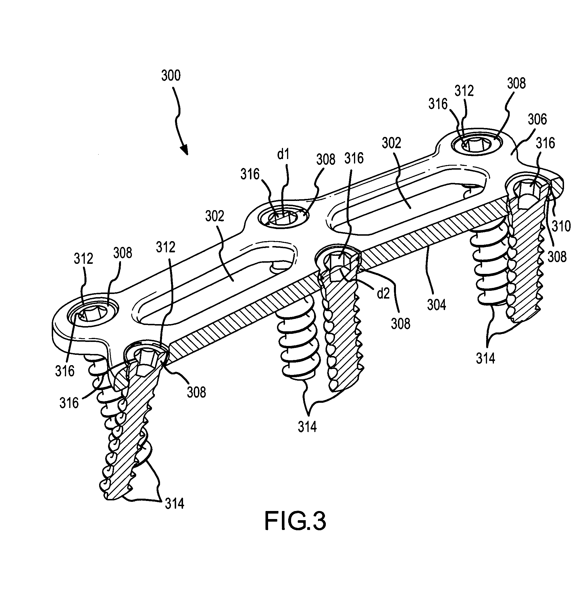 Cervical plate with backout protection