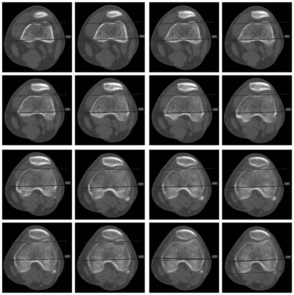 Reference system for rotational positioning of femoral prosthesis