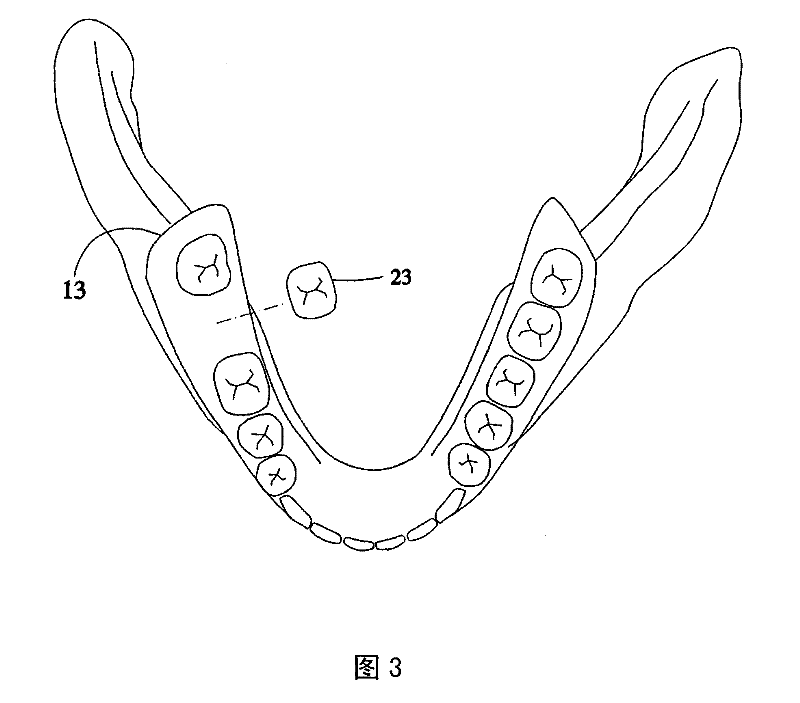 Digital supporting tooth design method by digital tooth implantation technology