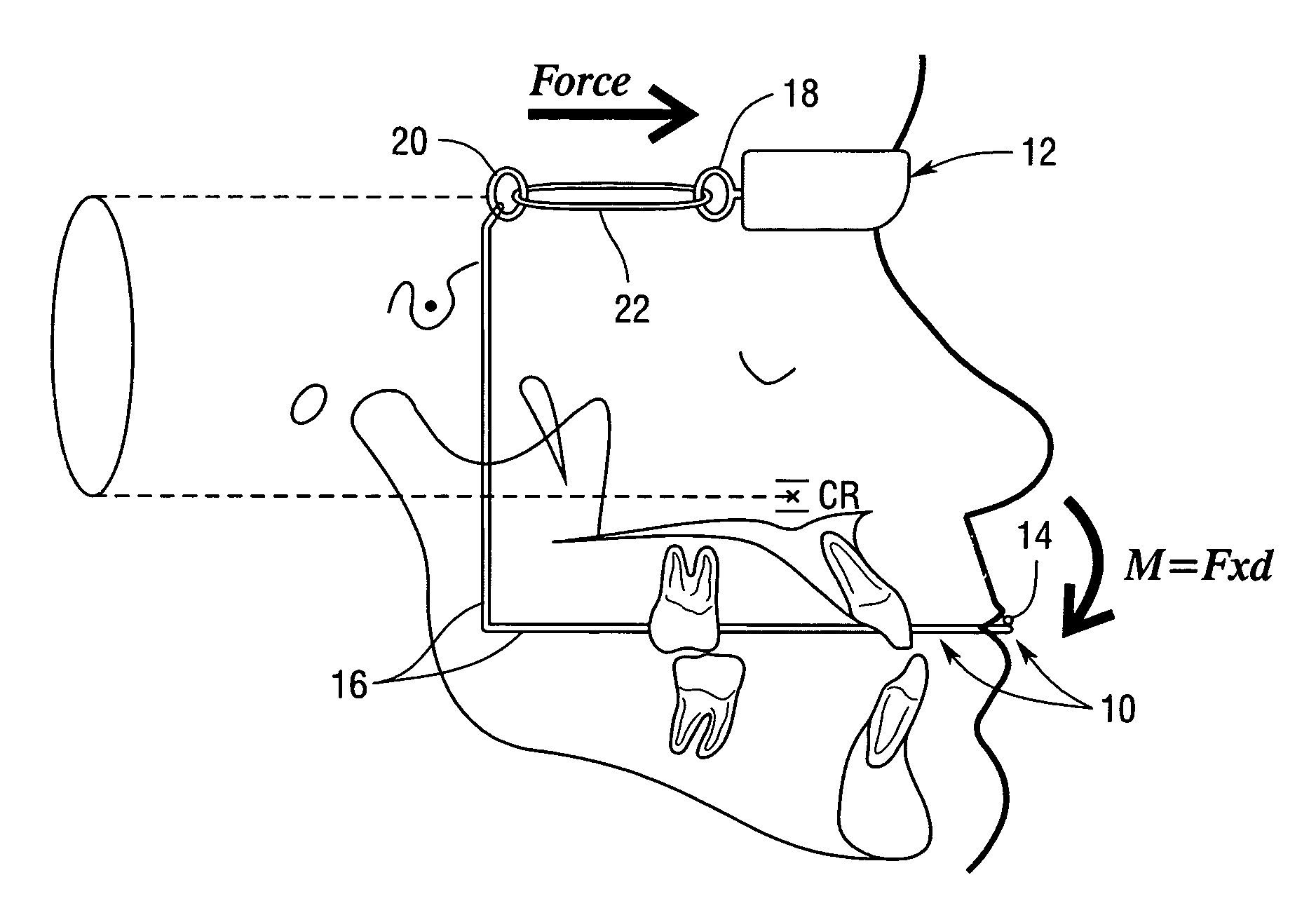 Newly developed face bow and protraction headgear in correction of anterior openbite class III patients