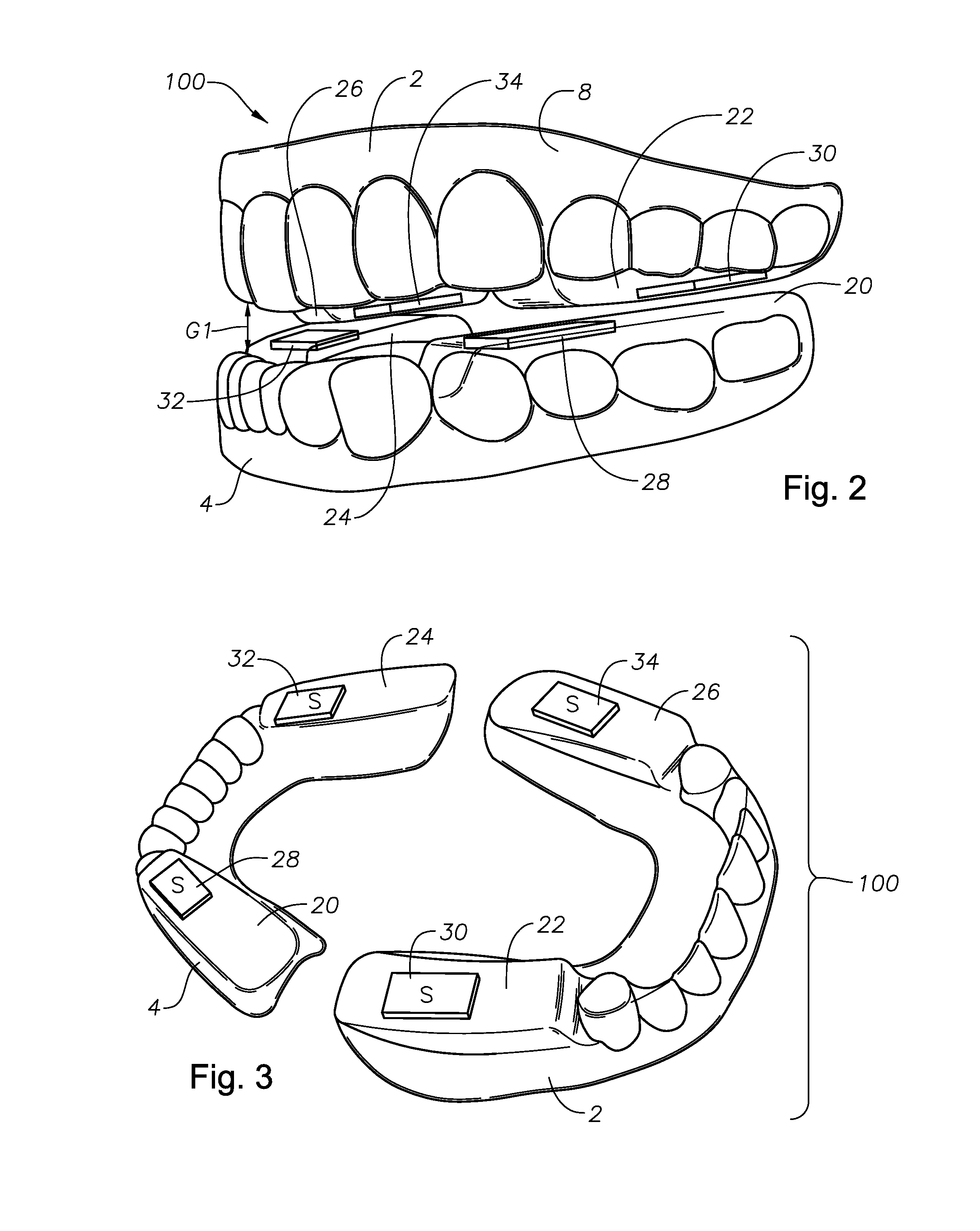 Oral devices, kits, and methods for reducing sleep apnea, snoring, and/or nasal drainage