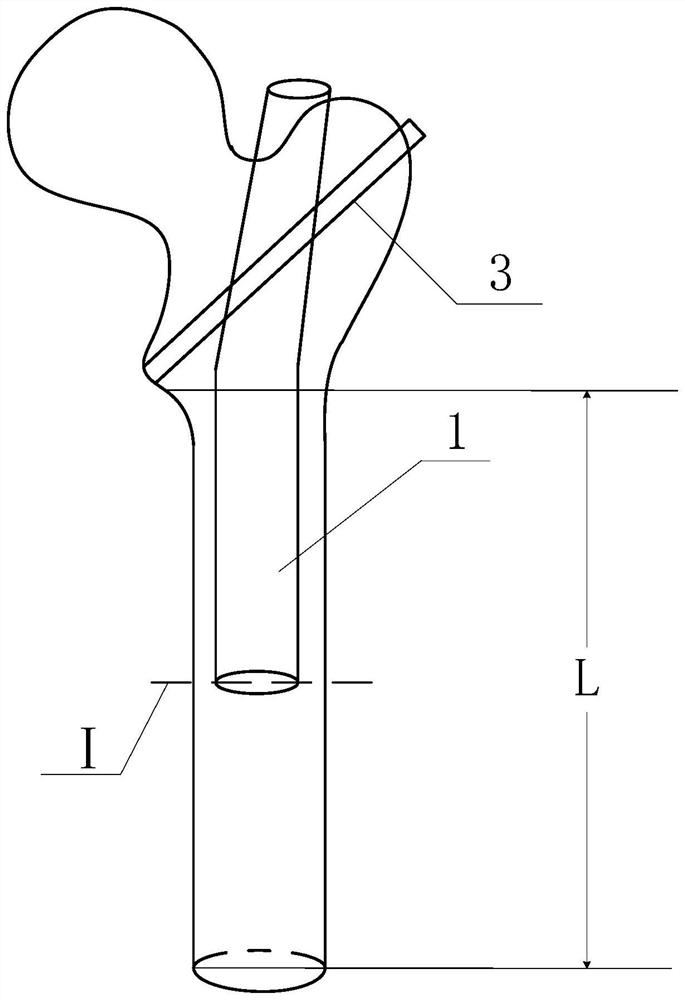 Implantable prosthetic device capable of lengthening amputation stump at middle-upper section of femur