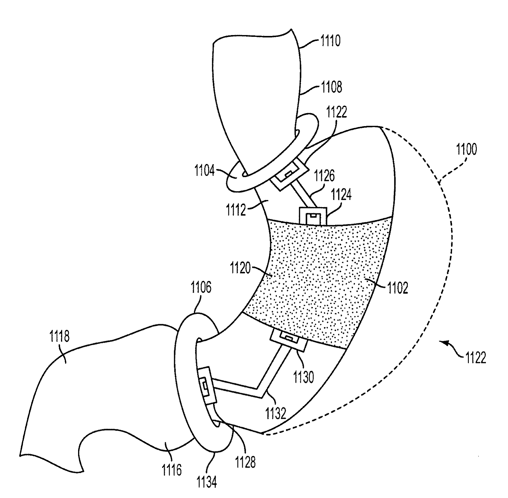 Method and apparatus for gastric restriction of the stomach to treat obesity