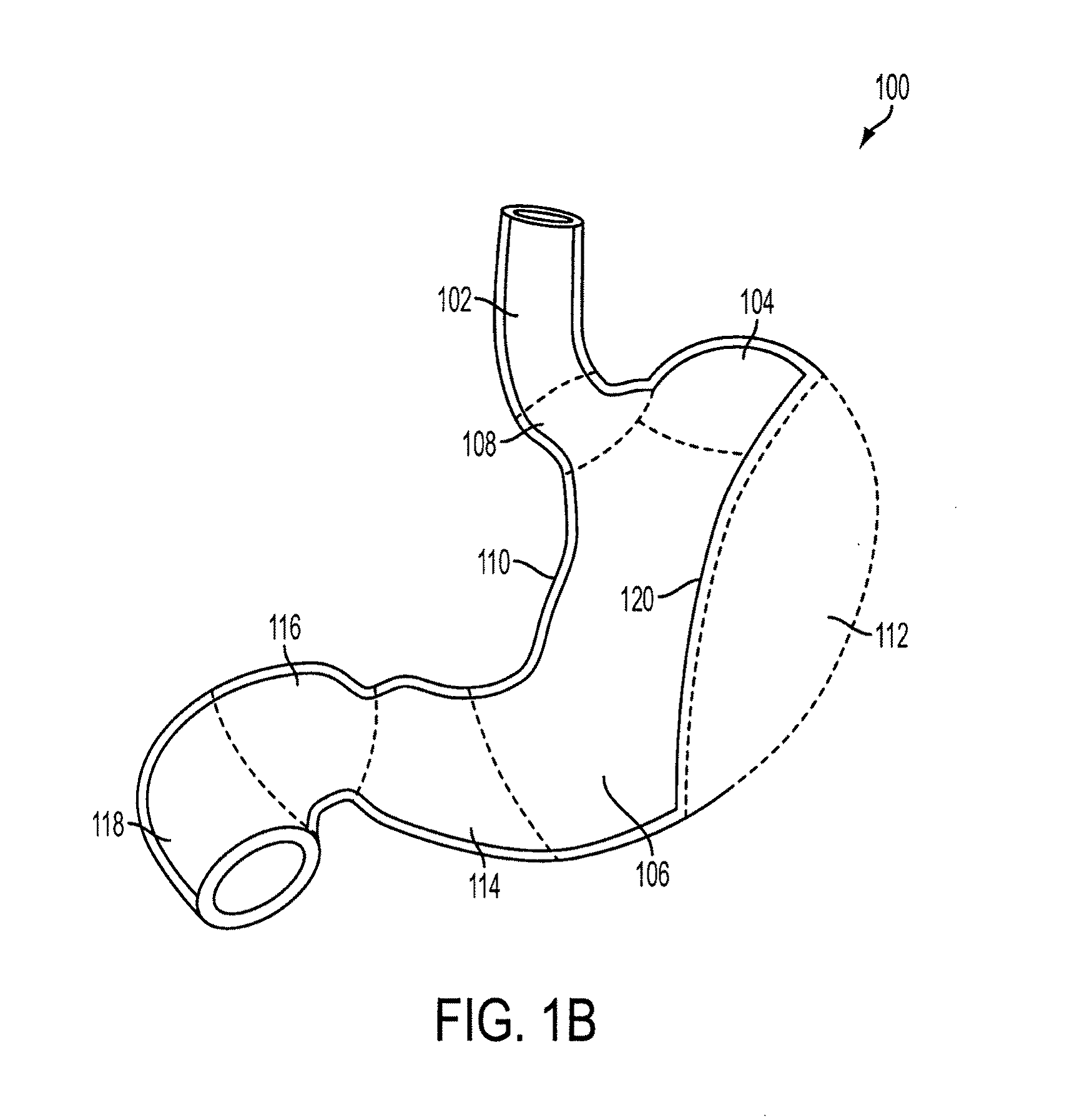 Method and apparatus for gastric restriction of the stomach to treat obesity