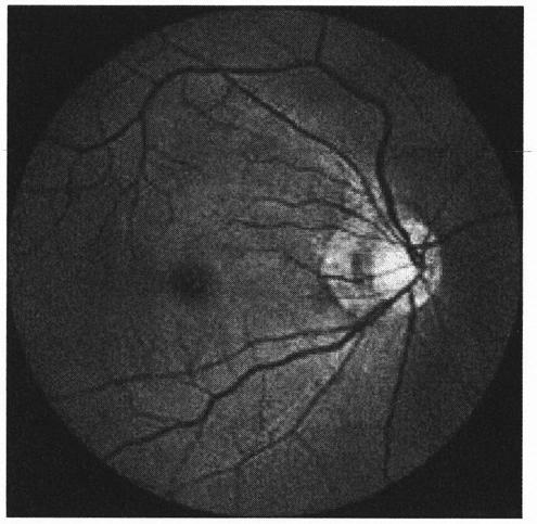 Method for detecting atrophic arc of high myopia fundus image based on machine learning