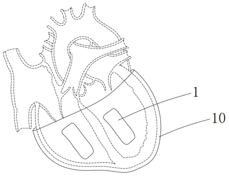 Heart stent for magnetomotive heart auxiliary power system and system