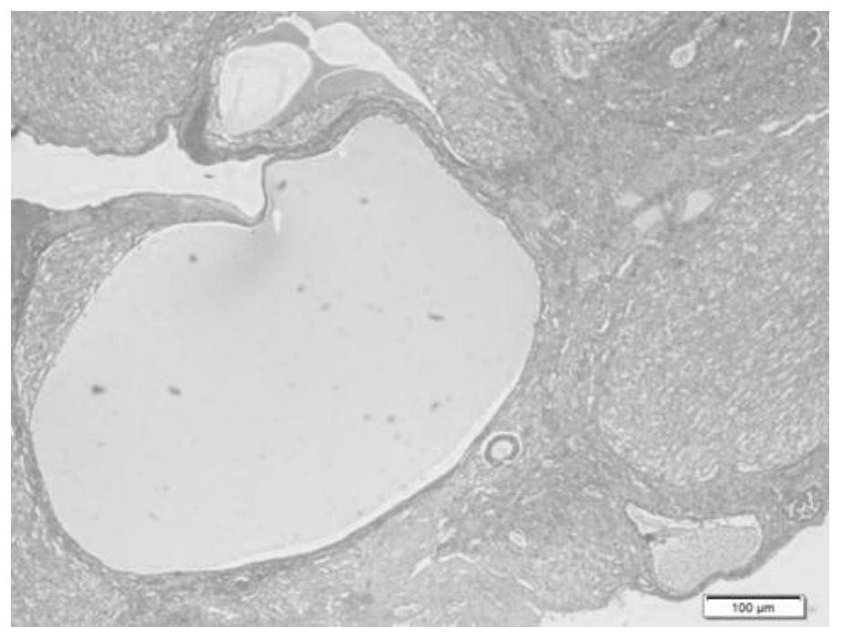 A traditional Chinese medicine composition for treating polycystic ovary syndrome and its preparation method and application