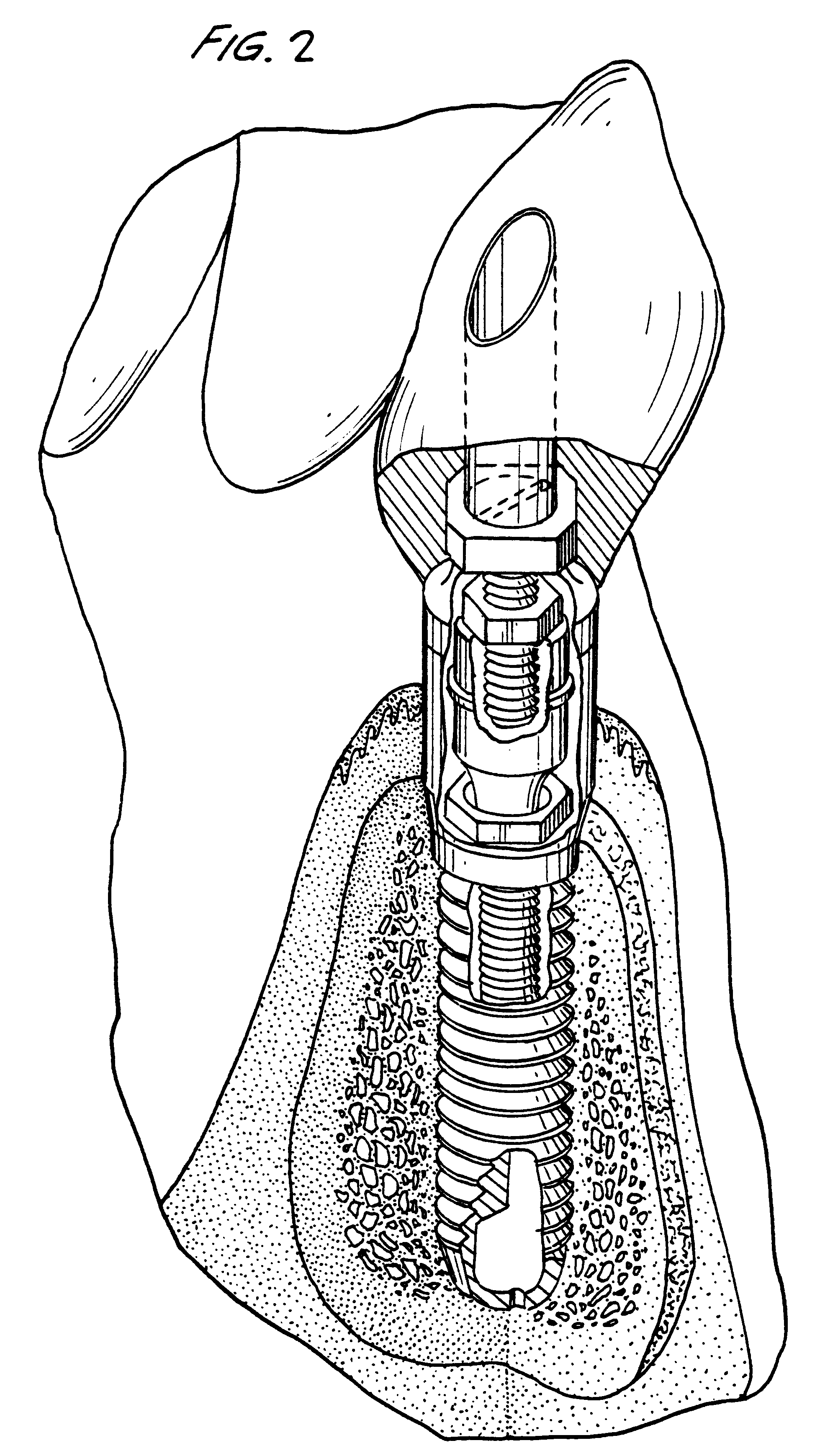 Titanium material implants