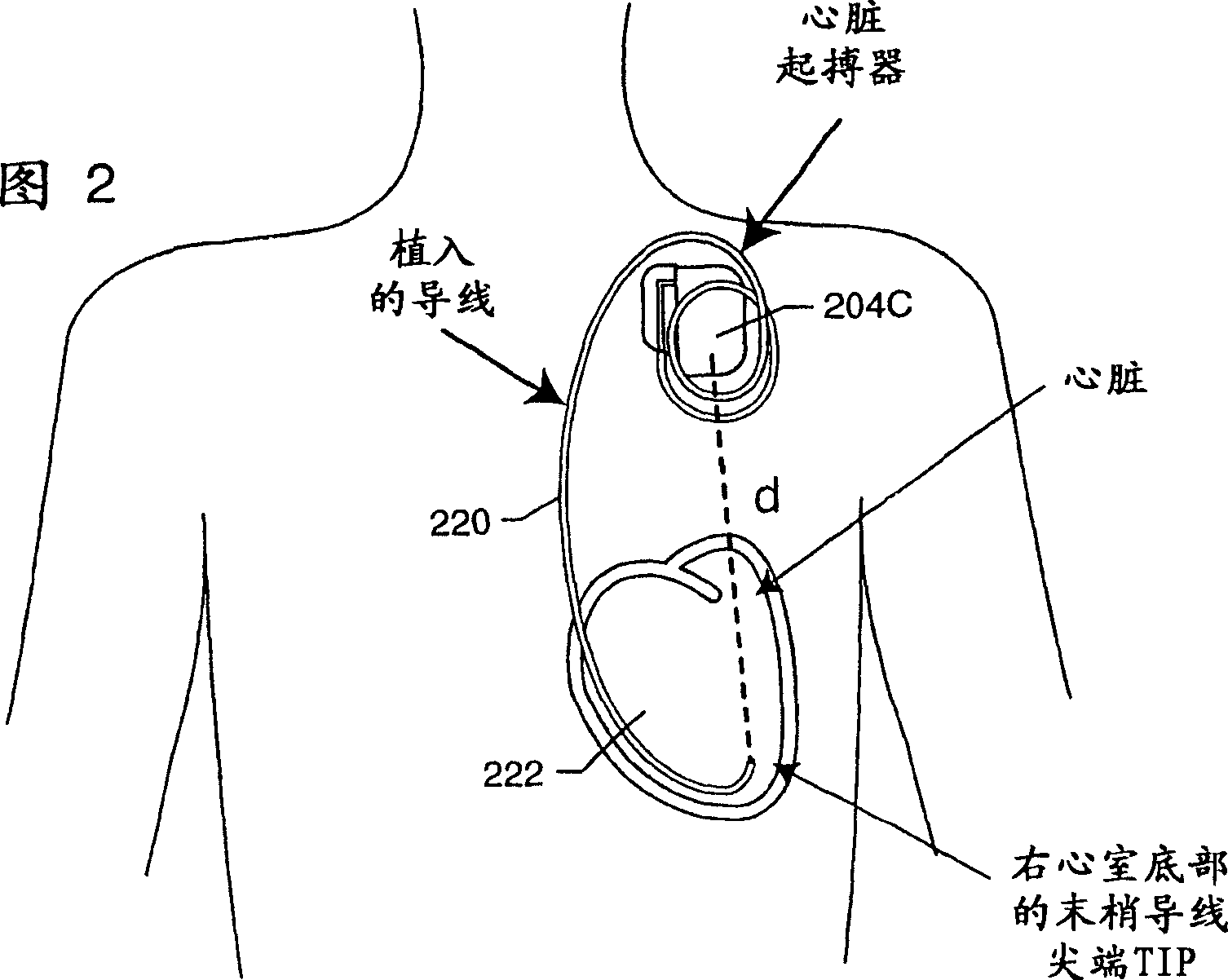 Apparatus and process for reducing the susceptability of active implantable medical devices to medical procedures such as magnetic resonance imaging