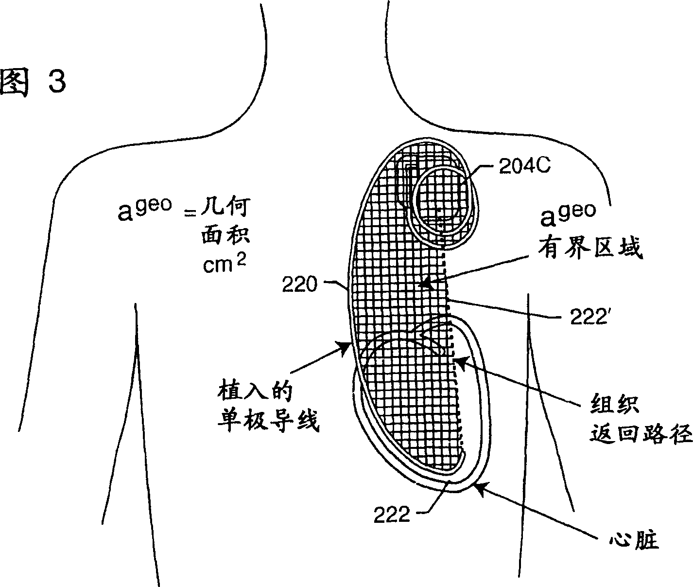 Apparatus and process for reducing the susceptability of active implantable medical devices to medical procedures such as magnetic resonance imaging