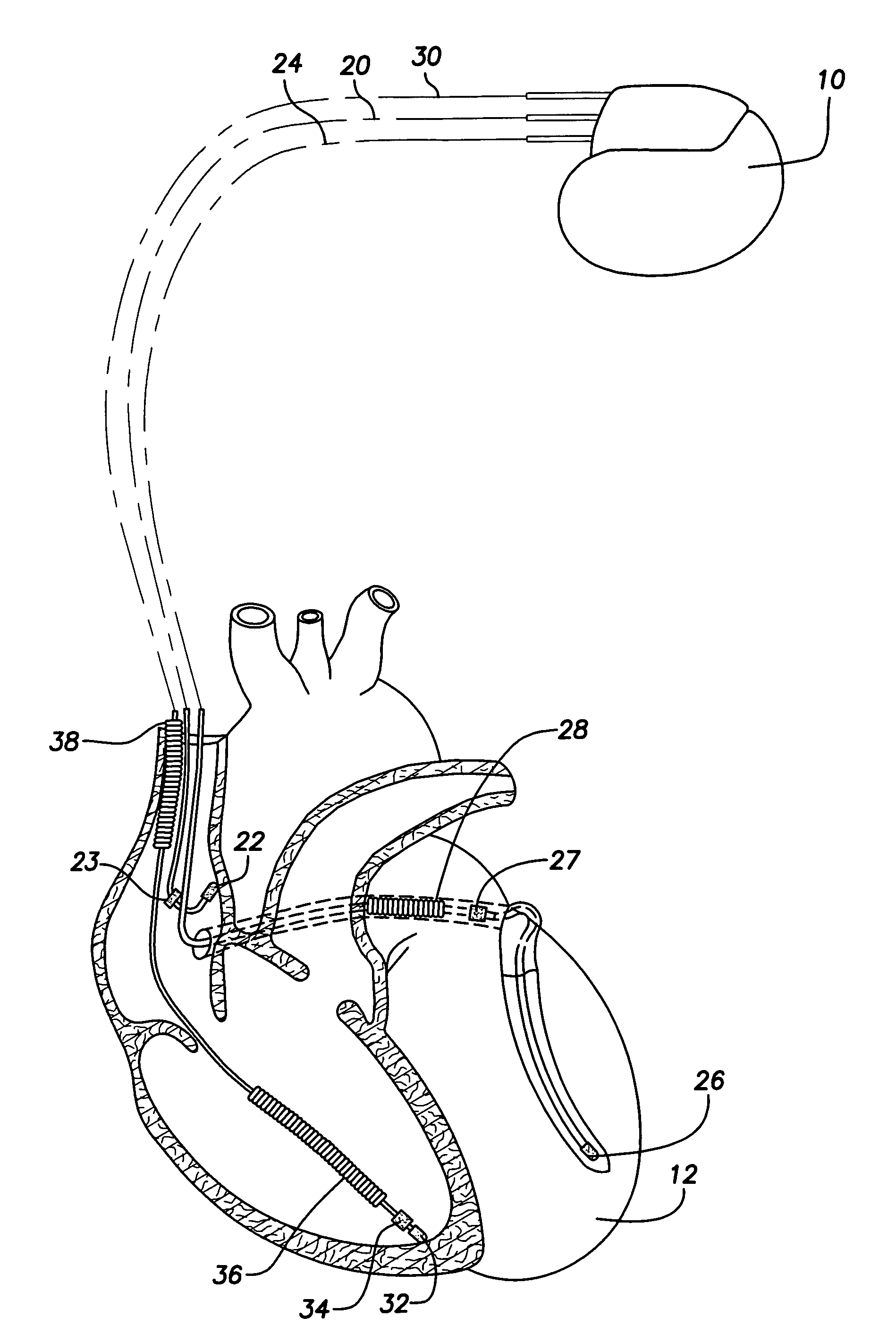 System and method for providing preventive overdrive pacing and antitachycardia pacing using an implantable cardiac stimulation device