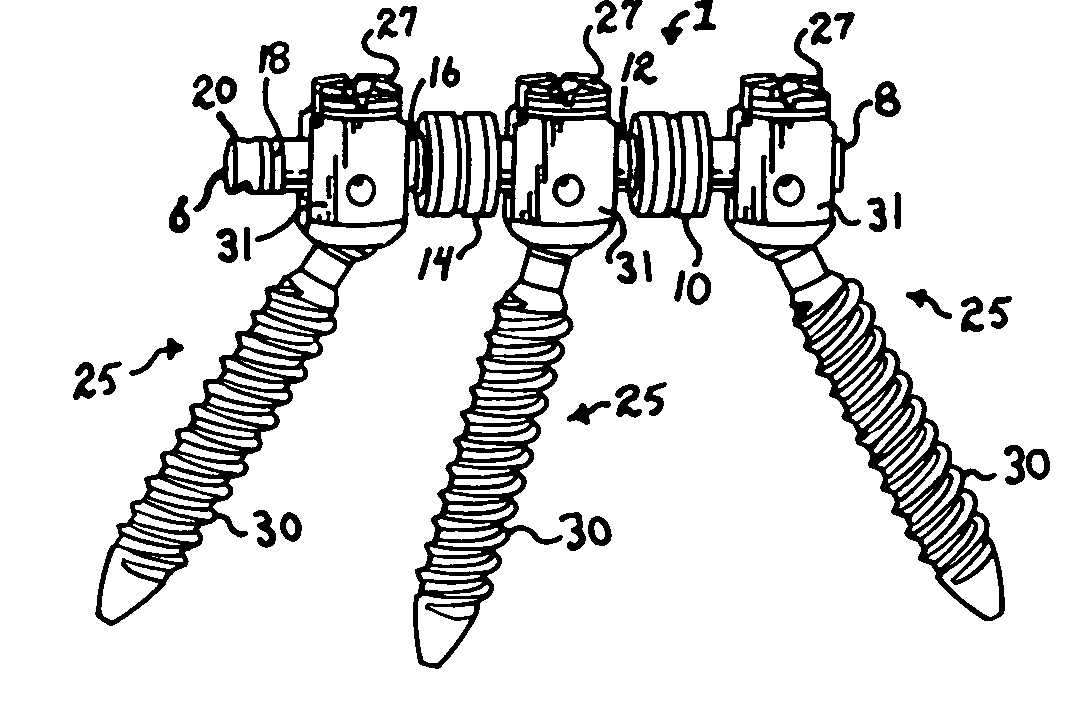 Dynamic stabilization connecting member with pre-tensioned solid core