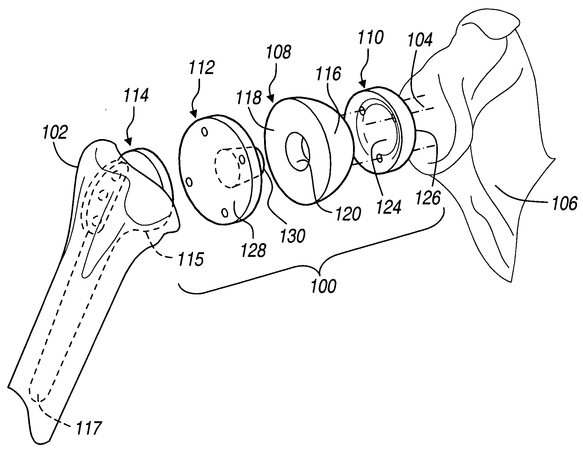 Shoulder implant assembly