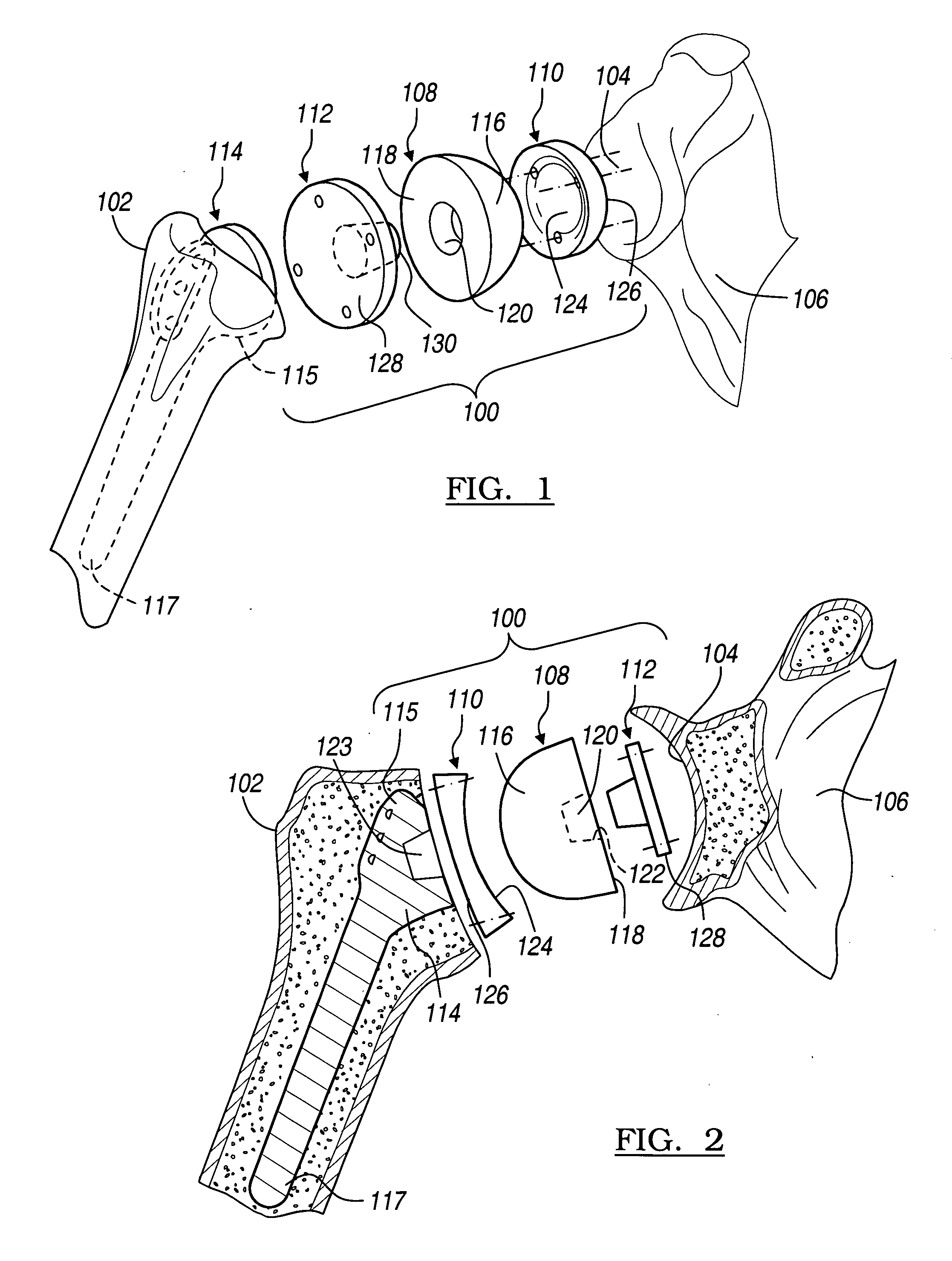 Shoulder implant assembly