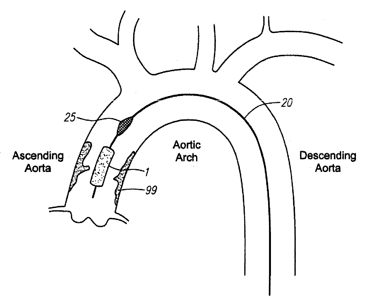 Methods and devices for treatging aortic atheroma